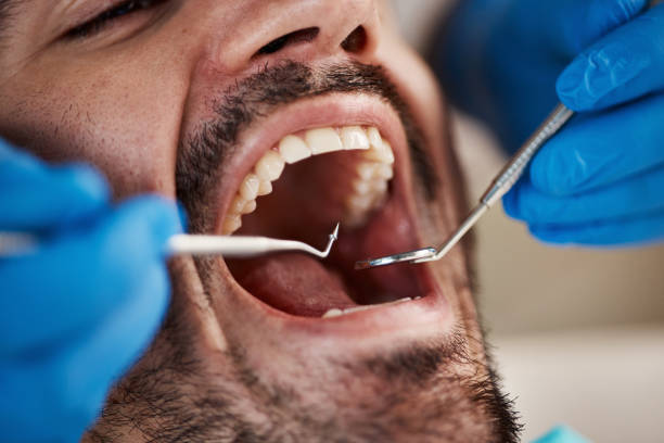 Emergency Treatment for Knocked-Out Teeth